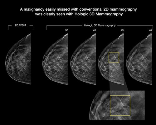 Example of how a 3D Mammography can identify more malignancy than 2D Mammography